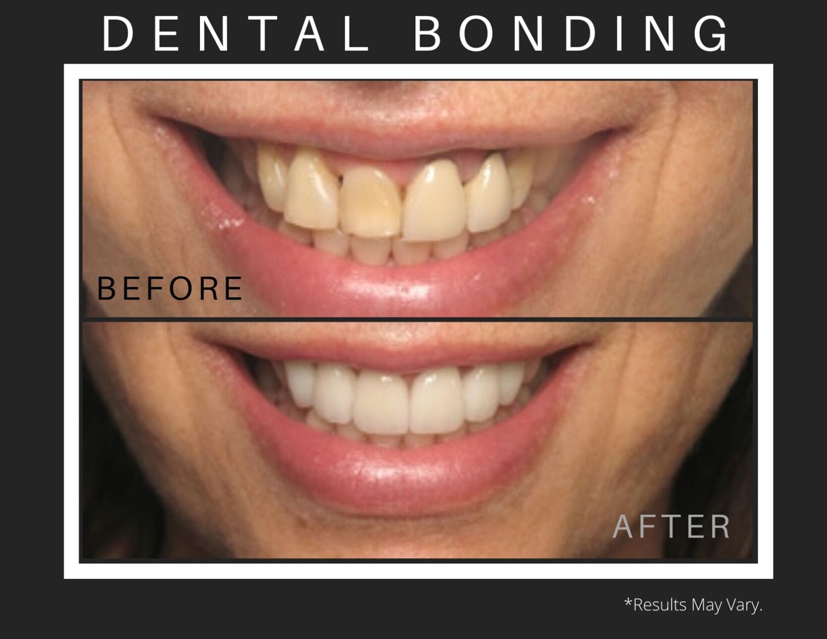 Dental Bonding